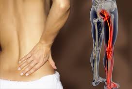 Top 10 Most Burning Questions About Sciatica