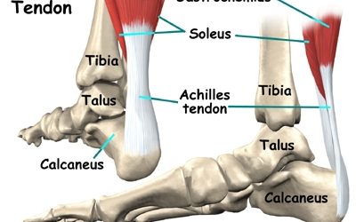 Foot or Heel Pain [Achilles Tendinitis]