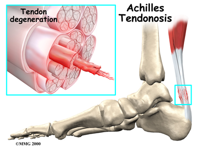 foot_achilles_tendon_causes02