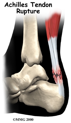 foot_achilles_tendon_intro01 (1)