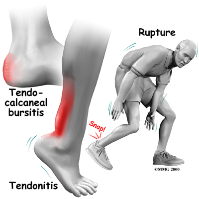 foot_achilles_tendon_symptoms01